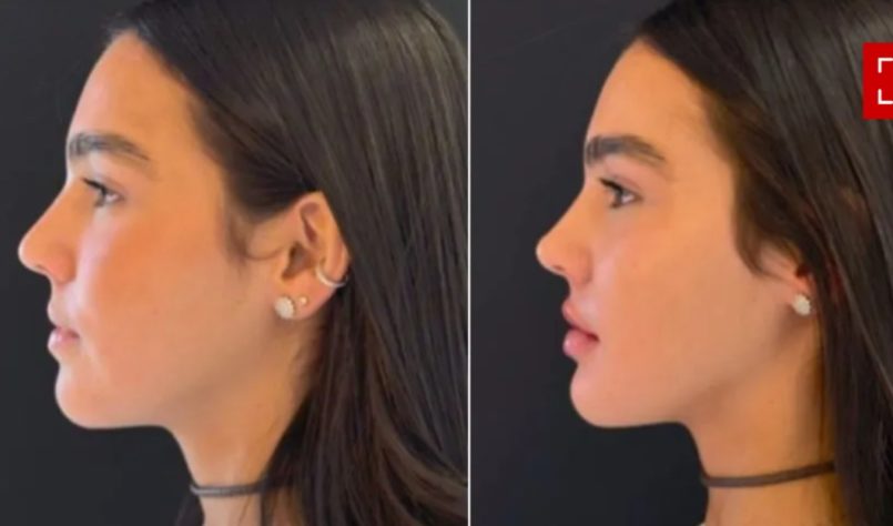 harmonização facial