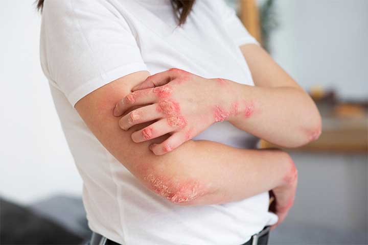 Além disso, o uso tópico pode causar irritações na pele. Em caso de reações alérgicas graves, como dificuldade para respirar ou inchaço, é necessário procurar ajuda médica imediatamente.