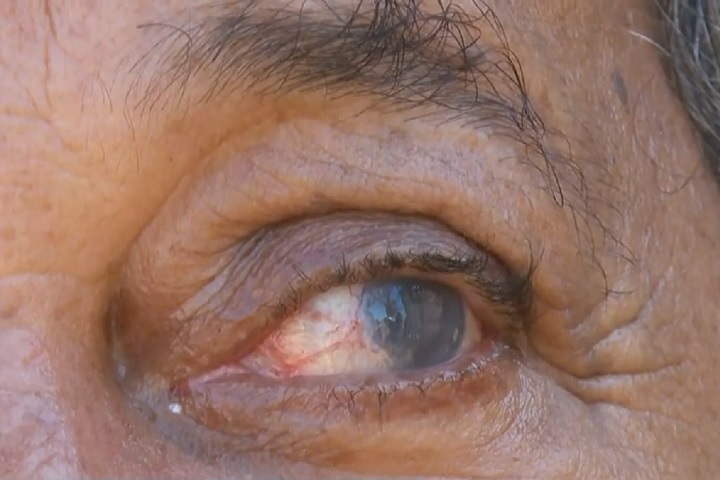 Os pacientes também criticam a falta de apoio do AME e da Santa Casa de Franca. Segundo eles, medidas como fornecimento de colírios e inclusão na fila de transplante só ocorreram depois de muita insistência.