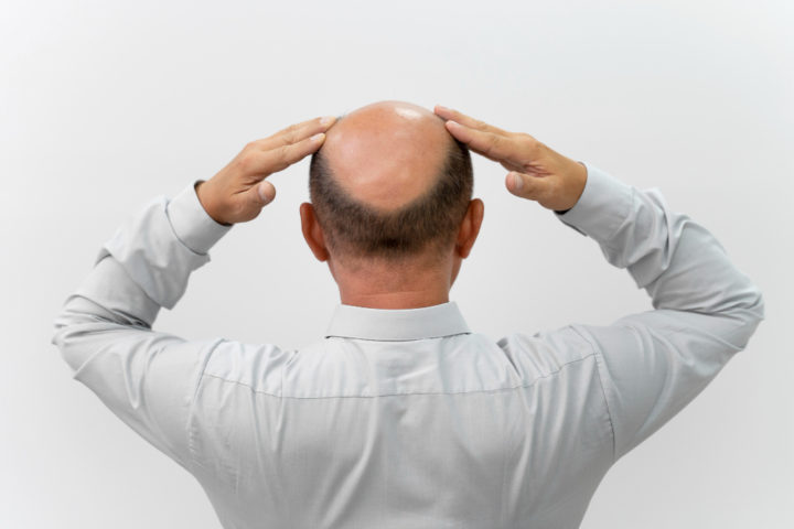 Hoje, sabe-se que o minoxidil melhora a circulação nos folículos capilares, fornecendo mais oxigênio e nutrientes, além de prolongar a fase de crescimento do cabelo (conhecida como anágena).