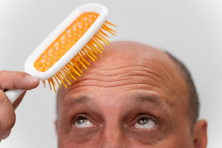Calvície - homem careca/calvo