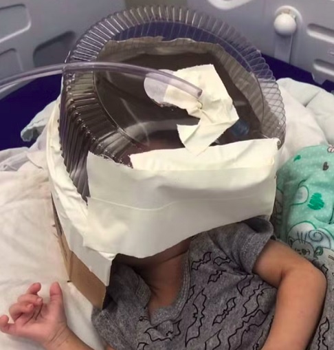 Embalagem de bolo: Em 2024, no Rio Grande do Norte, uma médica do precisou improvisar um respirador com uma embalagem de bolo para salvar a vida de um bebê que aguardava vaga na UTI.