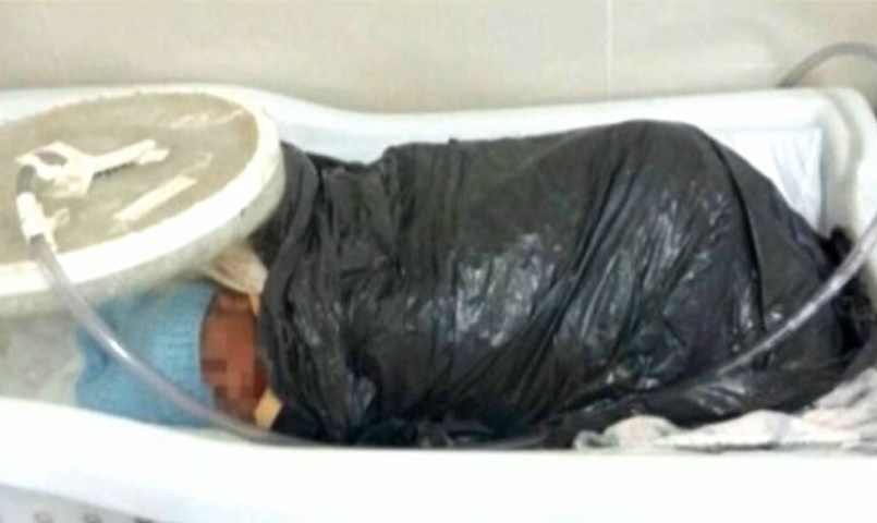Saco de lixo: Em 2015, no interior do Maranhão, na falta de incubadora os médicos usaram sacos de lixo para manter dois bebês prematuros aquecidos.