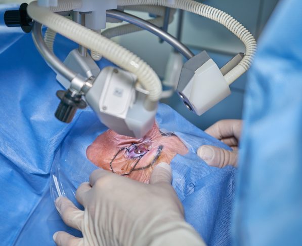 A única forma eficaz de tratar a catarata é por meio de cirurgia. O procedimento é seguro e altamente eficiente, com alta taxa de sucesso.