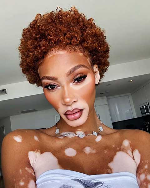 A canadense Winnie Harlow tem 91,26% de simetria facial. Seu nariz recebeu avaliação altíssima: 96,9%. Portadora de vitiligo, Winnie revolucionou o padrão da indústria ao desfilar com sua condição de pele e provar que a beleza é múltipla.