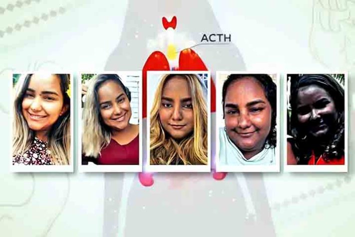 Tumor raro altera cor de pele de jovem cearense