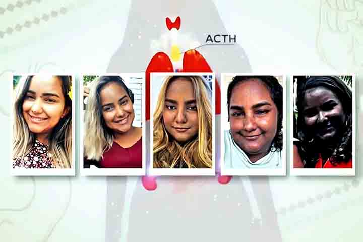 “Eu mudei de coloração muito rápido. Questão de meses, três, quatro meses”, contou Sabrina, referindo-se à pigmentação alterada de pacientes que têm superprodução de ACTH.-- ©Reprodução de vídeo TV Globo