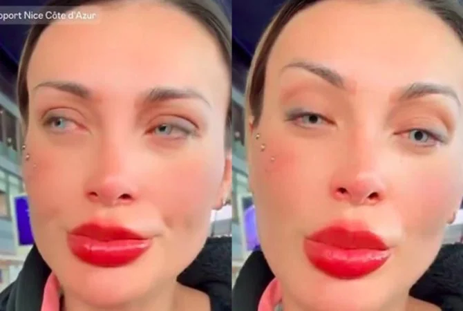 Andressa Urach relata dores após cirurgia para mudar cor dos olhos: ‘Medo de ficar cega’