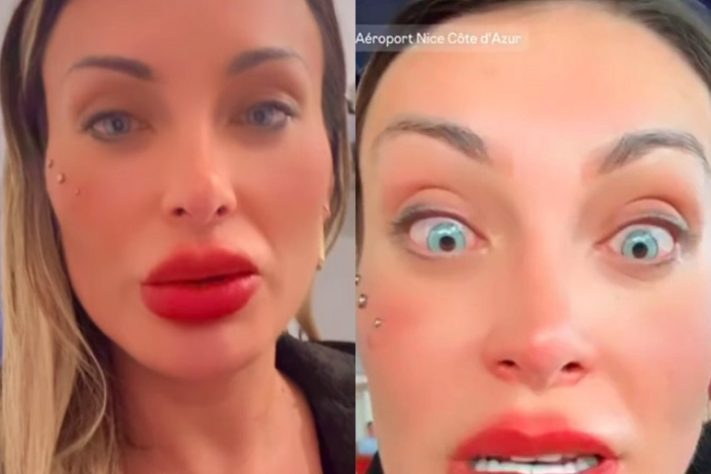 Montagem - Andrerssa Urach revela medo de ficar cega após cirurgia para mudar a cor dos olhos