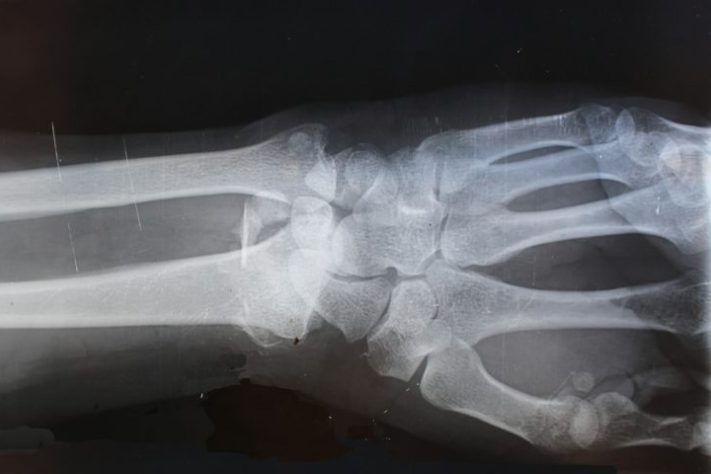 Raio-X - osso humano
