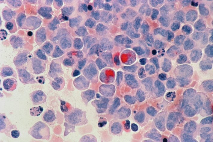 Células cancerígenas - foto NEUTRA