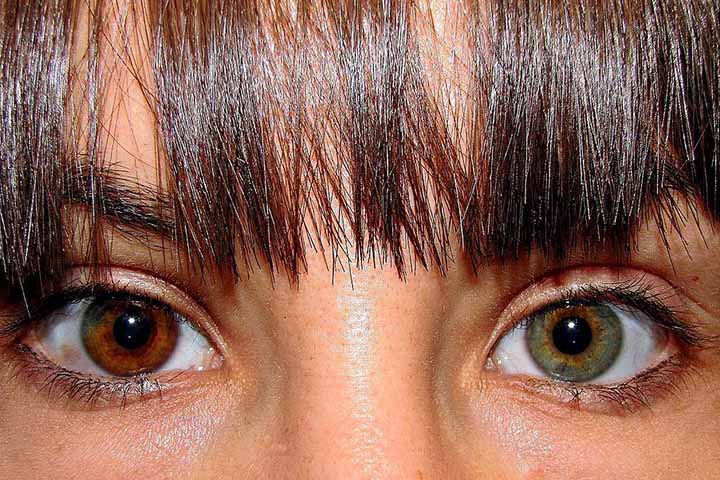 A heterocromia é uma condição caracterizada pela diferença de coloração entre as íris dos olhos. Ela pode fazer com que cada olho tenha uma cor diferente ou provocar variações de tonalidade em uma mesma íris. Pode ser congênita ou surgir ao longo da vida. -  (crédito:  Xavier Nájera/Wikimédia Commons)