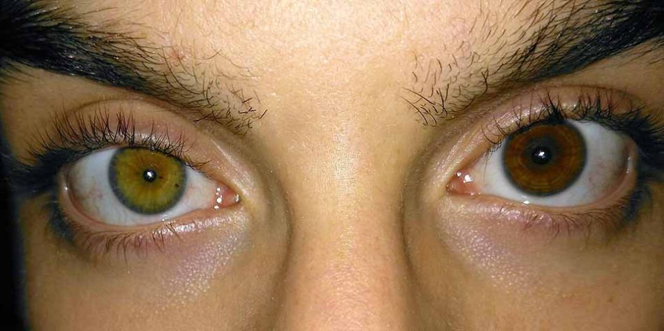 Famosos com heterocromia 