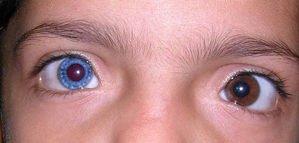 A heterocromia pode ocorrer de duas formas principais: a heterocromia completa, quando cada olho tem uma cor diferente - por exemplo, um azul e outro castanho - e a heterocromia parcial, quando um mesmo olho tem duas cores distintas, como uma mancha de outra cor dentro da Ã­ris.


