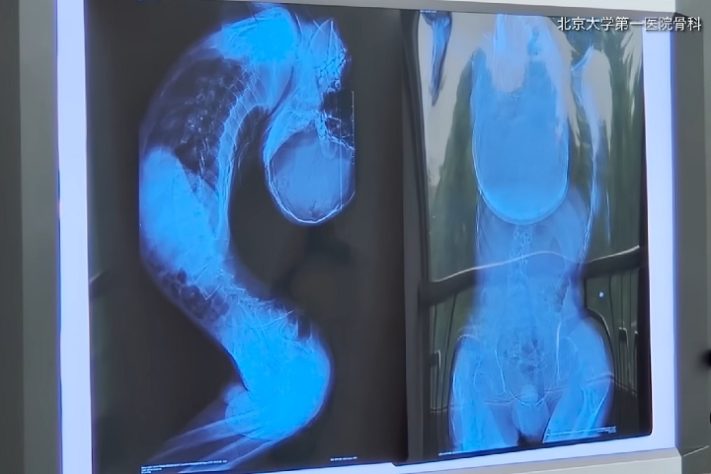 Jovem estudante chinês de 21 anos passa por cirurgia e conserta condição extrema na coluna