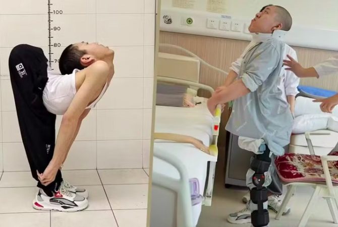 Após tratamento complexo, ‘menino dobrado’ chinês consegue deitar pela 1ª vez