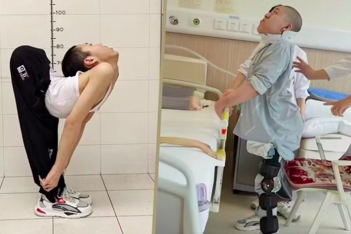 Jovem estudante chinês de 21 anos passa por cirurgia e conserta condição extrema na coluna