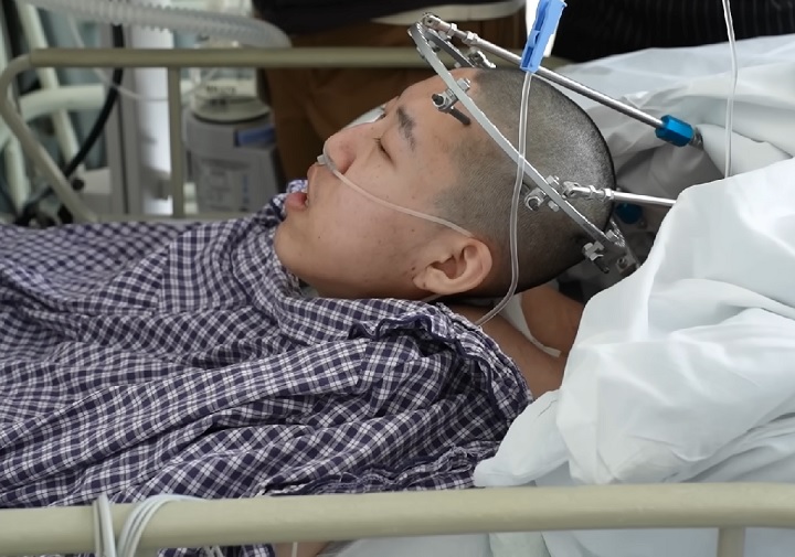 Jiang Yanchen, natural da província de Shandong, no norte da China, conseguiu deitar de costas pela primeira vez após o procedimento bem-sucedido.