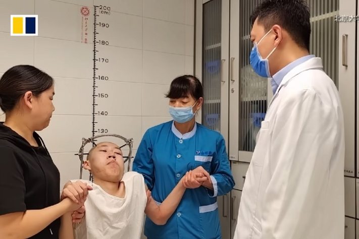 Jovem estudante chinês de 21 anos passa por cirurgia e conserta condição extrema na coluna