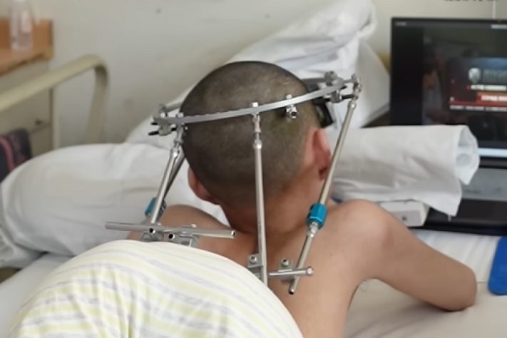 Jovem estudante chinês de 21 anos passa por cirurgia e conserta condição extrema na coluna