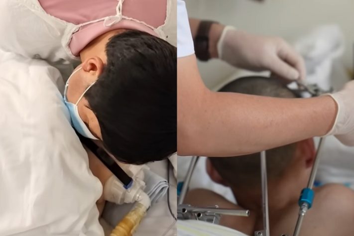 Montagem - Jovem estudante chinês de 21 anos passa por cirurgia e conserta condição extrema na coluna
