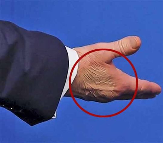 Insuficiência venosa crônica - Donald Trump