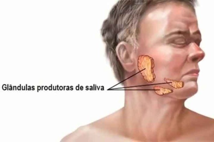 Caxumba