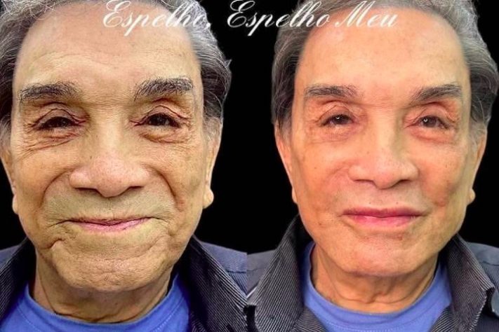 Harmonização facial Dedé Santana - Reprodução/Instagram