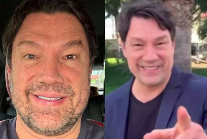 Veja celebridades que assumiram ter feito harmonização facial
