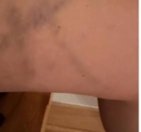 Atriz fica com estranhos hematomas durante gravações de filme de terror