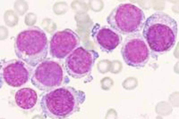Leucemia