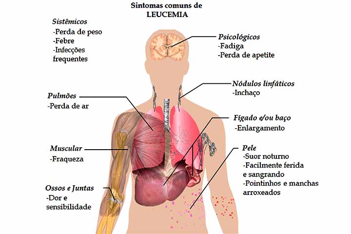 <p>Outros sintomas da doença são: Infecções recorrentes, pela baixa de glóbulos brancos funcionais; febre persistente, perda de peso e suores noturnos; em alguns casos, aumento do fígado, baço ou linfonodos.</p>
