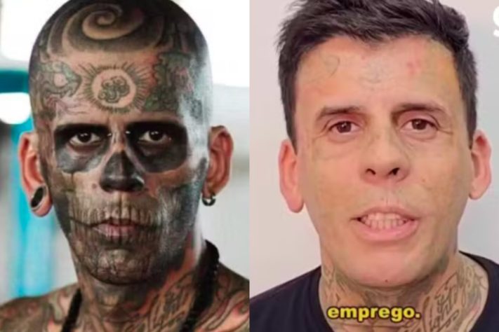 Homem mais tatuado do Brasil passa por processo de remoção das tatuagens - Montagem/Arquivo Pessoal