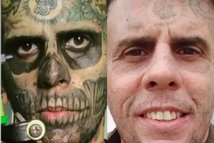 A remoção já passou por cinco sessões e deve precisar pelo menos mais três para ser concluída.