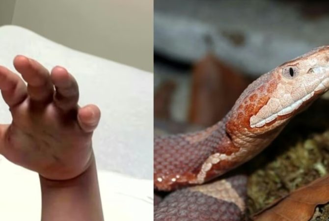 Menino é picado por cobra venenosa e funcionários de creche pensam que é farpa