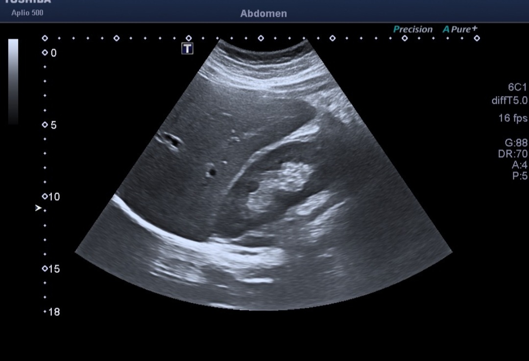 Sua detecção costuma ser tardia, pois os sintomas iniciais são sutis ou até imperceptíveis. Por isso é preciso ficar atento e fazer exames preventivos. 