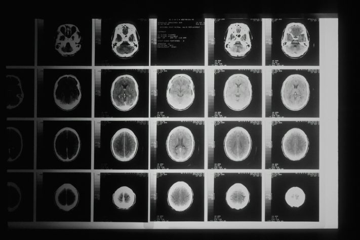 Cérebro - National Cancer Institute/Unsplash