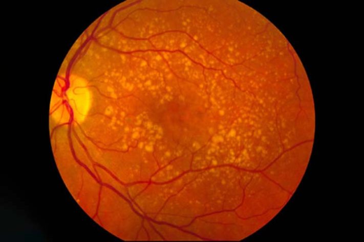 Degeneração macular
