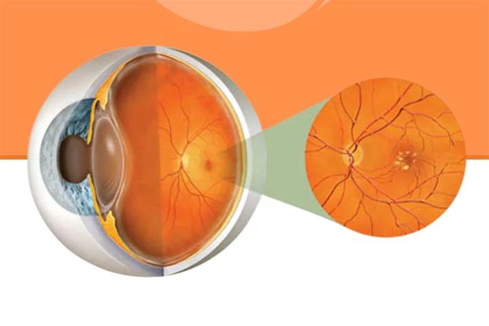 Degeneração macular