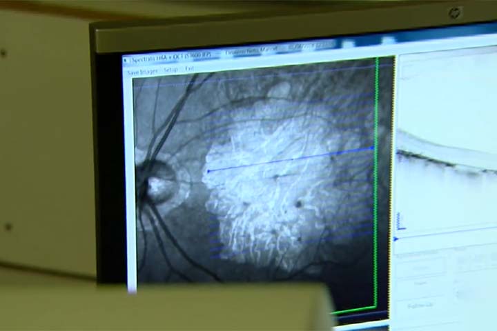 Embora ainda nÃ£o exista cura, hÃ¡ formas de retardar sua progressÃ£o e, em alguns casos - especialmente na DMRI Ãºmida - preservar parte da visÃ£o com tratamentos como injeÃ§Ãµes intraoculares, laser ou terapias medicamentosas especÃ­ficas. 
