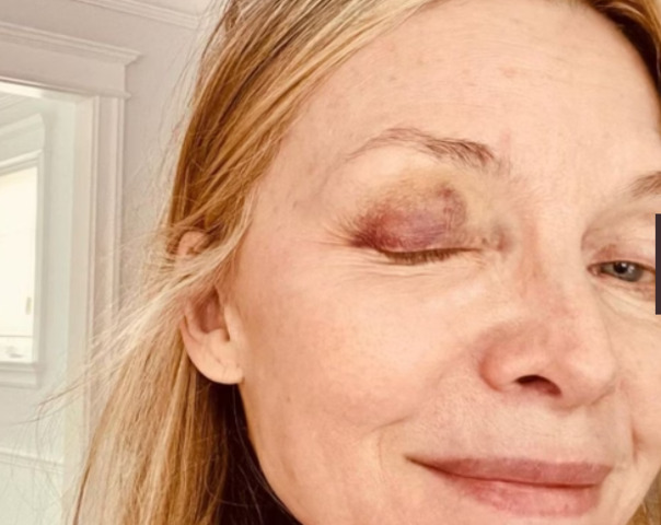 No fim de 2023, ela surgiu com um olho roxo, causando apreensão nos fãs. E explicou nas redes sociais que tinha sofrido um acidente doméstico com bola de pickleball. 