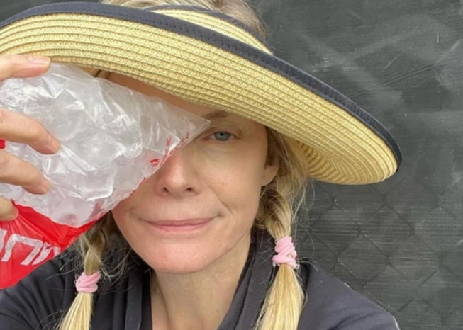 Em seguida, ela postou imagem colocando um saco de gelo no olho e fez o alerta para que as pessoas não brinquem com essa bolinha oca em qualquer lugar. “Aviso: pickleball, fique longe da cozinha”, postou. 