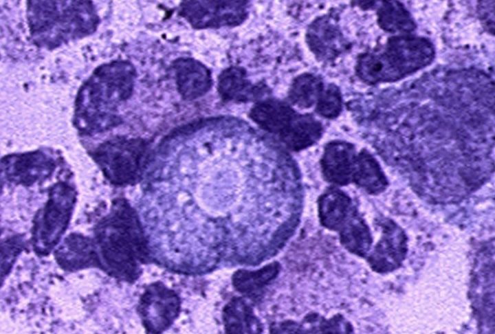 <p>Apesar de grande parte dessas amebas não representar perigo, algumas espécies podem provocar infecções graves e frequentemente fatais.</p>
