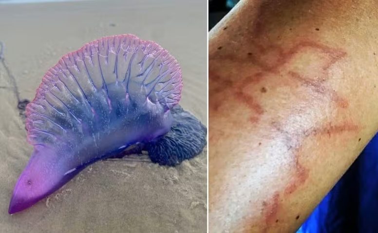 <p>Somente durante o feriado de Iemanjá, guarda-vidas registraram 576 atendimentos, com dez pessoas encaminhadas para a UPA, a maioria em estado moderado. O caso mais grave envolveu uma menina de 12 anos, com queimaduras no tórax.</p>
