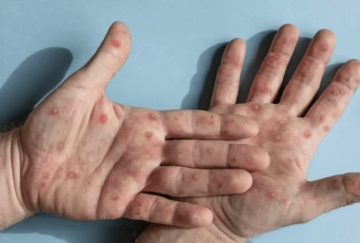 Mpox – Reprodução/Freepik