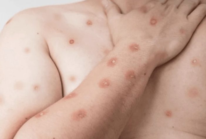 Mpox – Reprodução/Ministério da Saúde