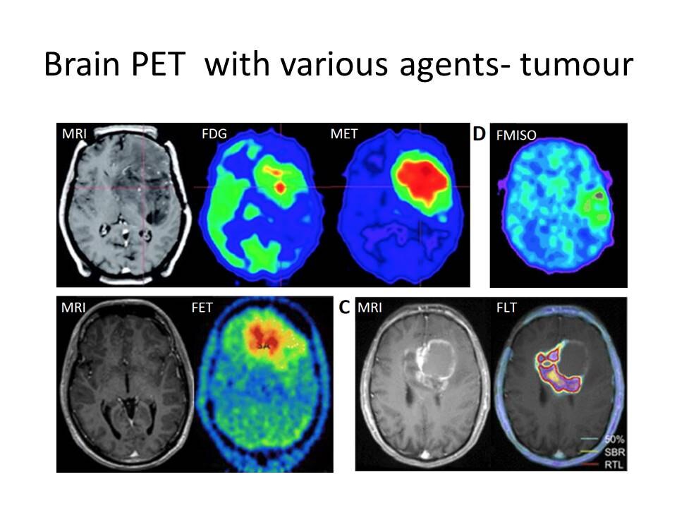 <p>O flúor também tem aplicações médicas em exames de imagem. Compostos fluoretados são usados em técnicas de PET scan, ajudando a diagnosticar doenças como câncer. Nesse exame da medicina nuclear, utiliza-se um radiofármaco chamado fluorodeoxiglicose (FDG), que contém o isótopo radioativo flúor-18.</p>
