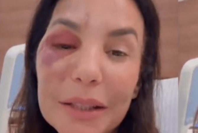 Ivete Sangalo passa por cirurgia após sofrer fraturas no rosto em acidente doméstico