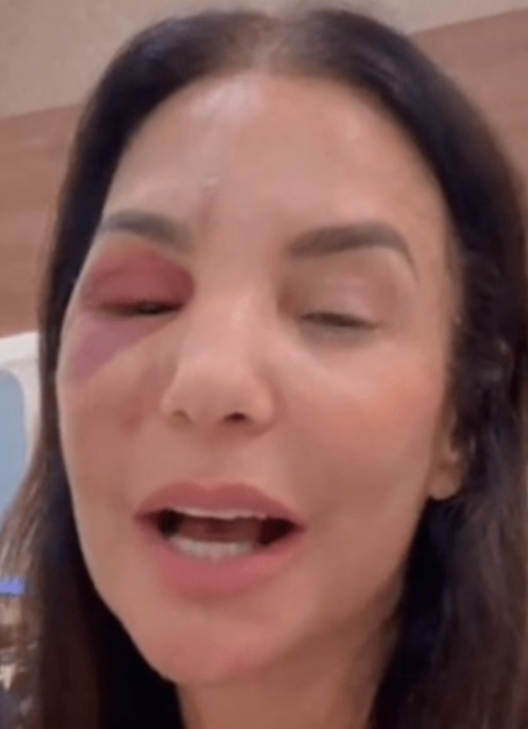 <p>Internada no Hospital Sírio-Libanês, em São Paulo, Ivete explicou que o procedimento foi realizado no domingo (1) e garantiu que está se recuperando bem. Bem-humorada, ela agradeceu o carinho do público e afirmou estar confiante na recuperação. A aparição reforçou a proximidade da cantora com os fãs, que lotaram as redes com mensagens de apoio. Ela disse que “não tá bonito, mas a fofa é simpática”.</p>
