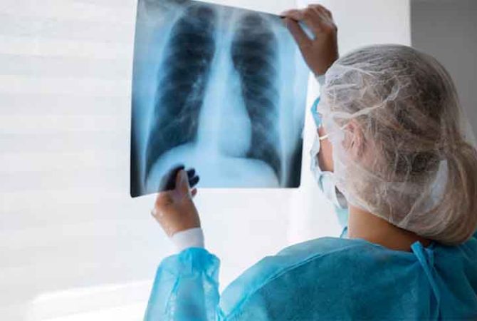 Doença antiga, ameaça atual: a persistência da tuberculose no século 21